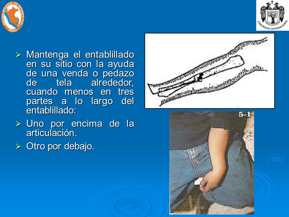 Mantenga el entablillado en su sitio con la ayuda de una venda o pedazo de tela alrededor, cuando menos en tres partes a lo largo del entablillado: