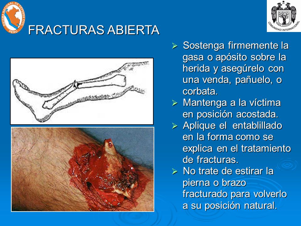 FRACTURAS ABIERTA Sostenga firmemente la gasa o apósito sobre la