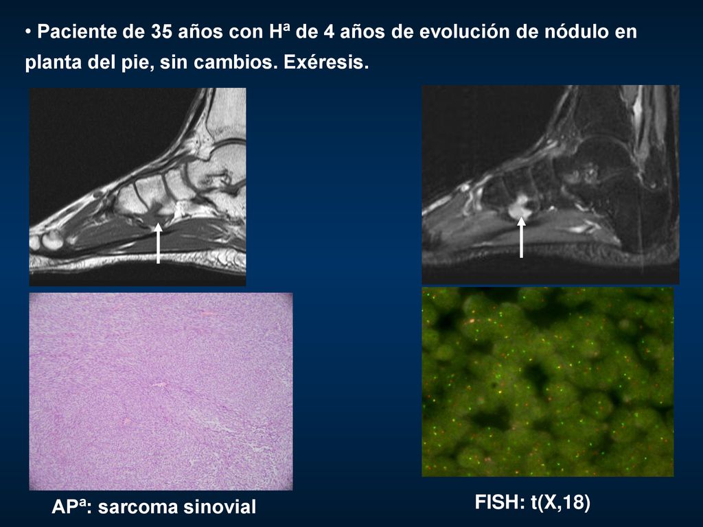Paciente de 35 años con Hª de 4 años de evolución de nódulo en planta del pie, sin cambios. Exéresis.