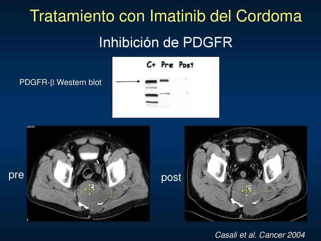 Tratamiento con Imatinib del Cordoma Inhibición de PDGFR