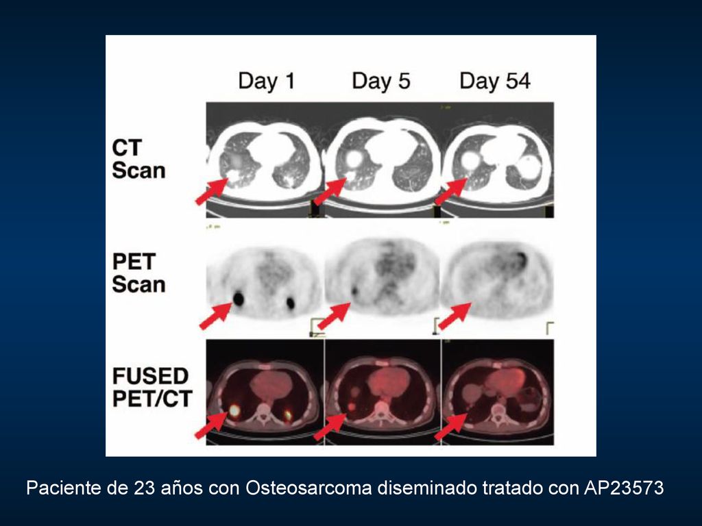 Paciente de 23 años con Osteosarcoma diseminado tratado con AP23573