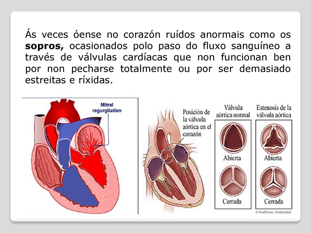 Ás veces óense no corazón ruídos anormais como os sopros, ocasionados polo paso do fluxo sanguíneo a través de válvulas cardíacas que non funcionan ben por non pecharse totalmente ou por ser demasiado estreitas e ríxidas.
