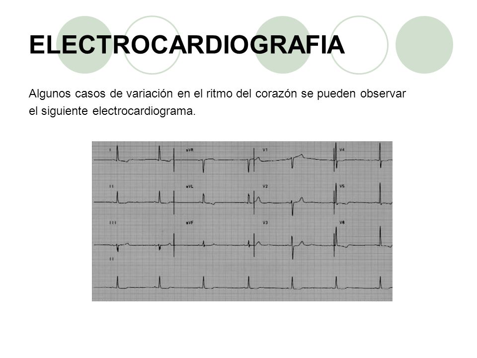 ELECTROCARDIOGRAFIA Algunos casos de variación en el ritmo del corazón se pueden observar. el siguiente electrocardiograma.
