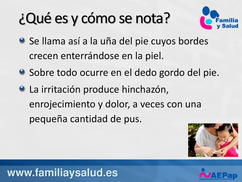 ¿Qué es y cómo se nota Se llama así a la uña del pie cuyos bordes crecen enterrándose en la piel.