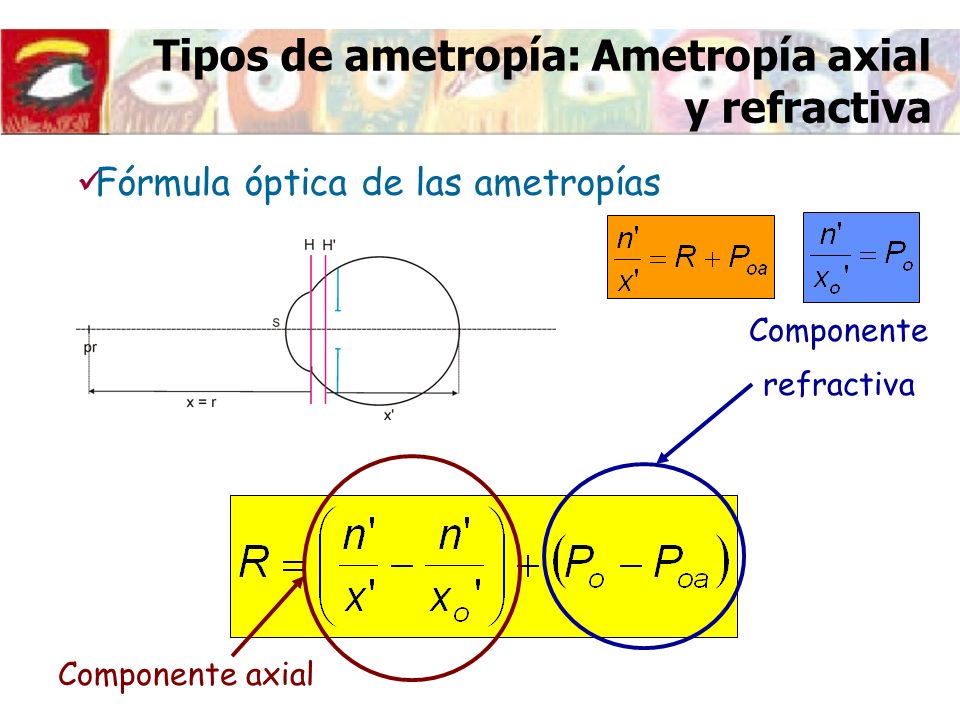 Tipos de ametropía: Ametropía axial y refractiva