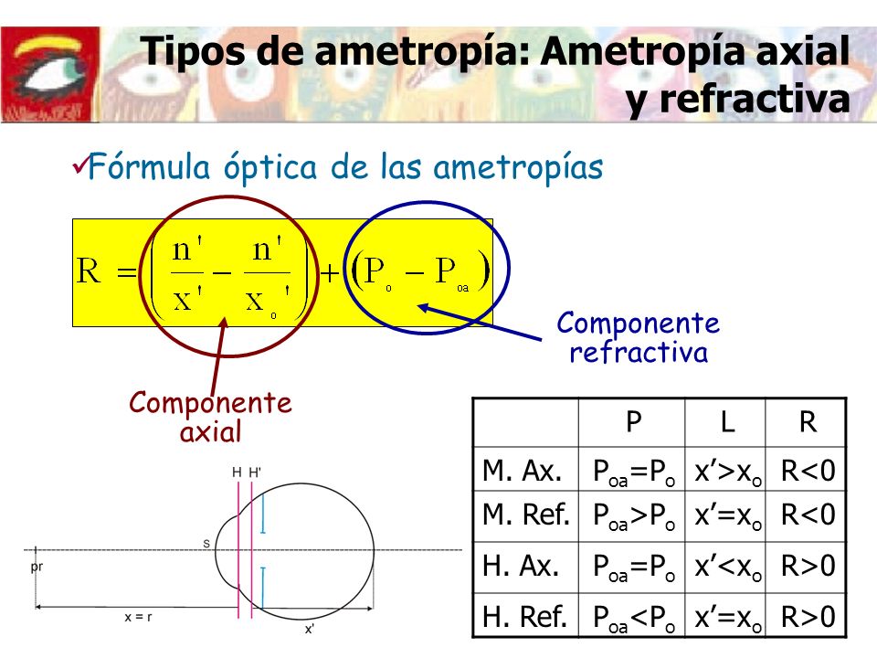 Tipos de ametropía: Ametropía axial y refractiva