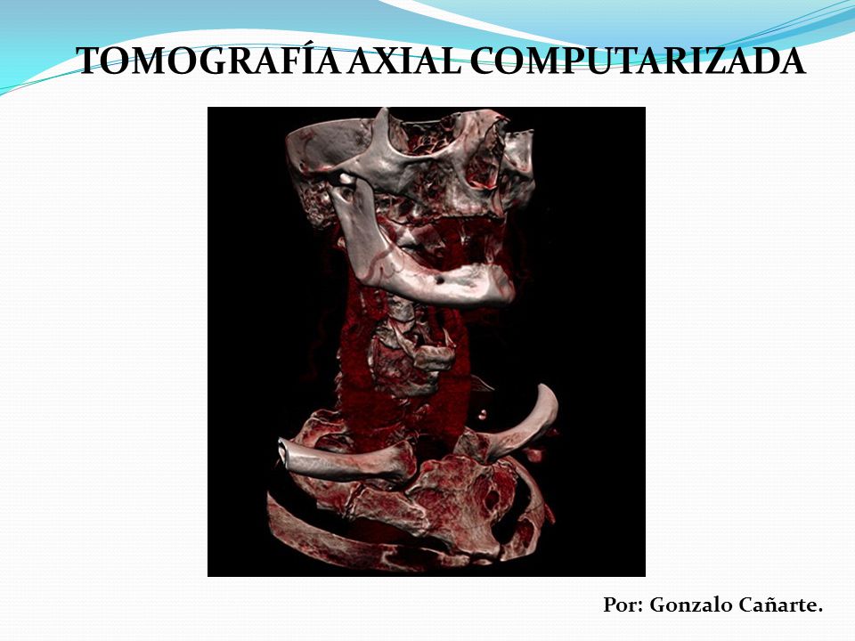 TOMOGRAFÍA AXIAL COMPUTARIZADA