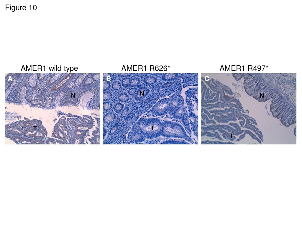 Figure 10 AMER1 wild type AMER1 R626* AMER1 R497* A B C N N N T T T