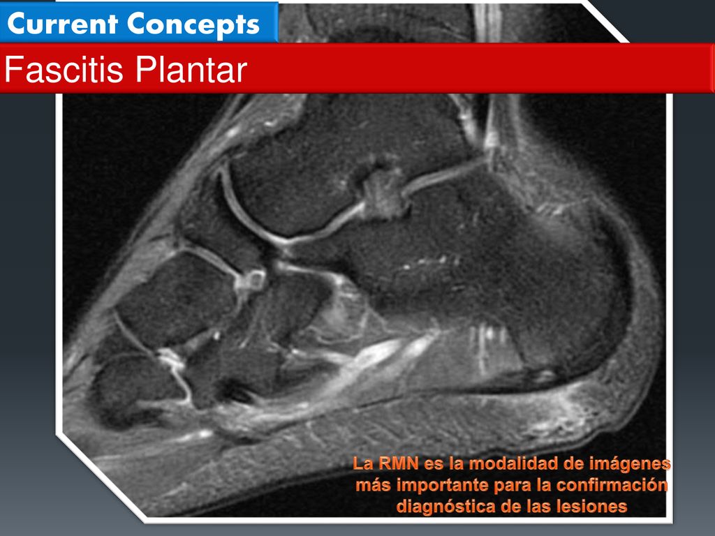 Fascitis Plantar Current Concepts La RMN es la modalidad de imágenes