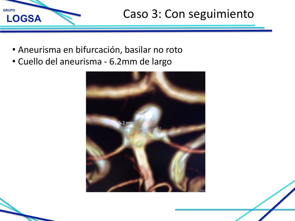 Caso 3: Con seguimiento Aneurisma en bifurcación, basilar no roto