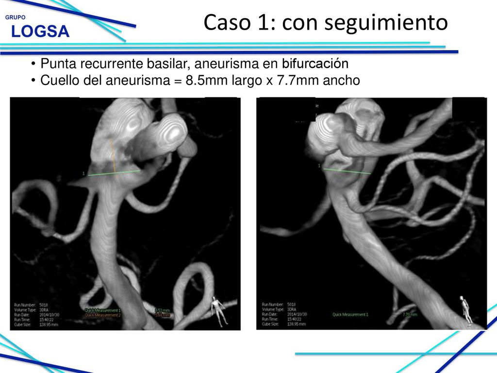 Caso 1: con seguimiento Punta recurrente basilar, aneurisma en bifurcación.