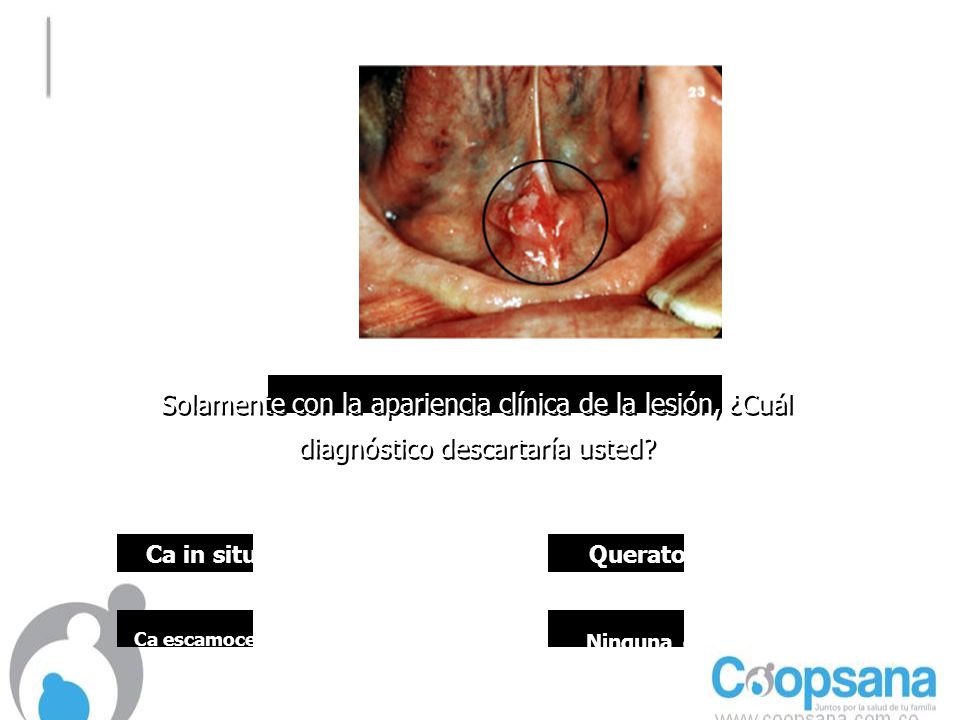 Ca escamocelular en piso de boca Ninguna de las anteriores
