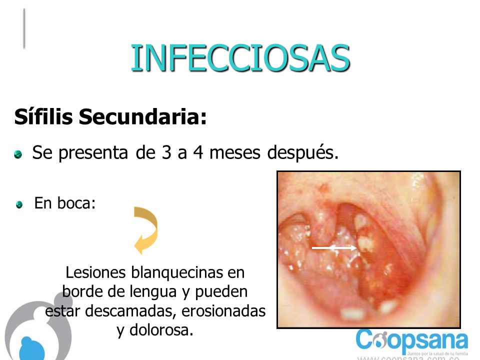 INFECCIOSAS Sífilis Secundaria: Se presenta de 3 a 4 meses después.