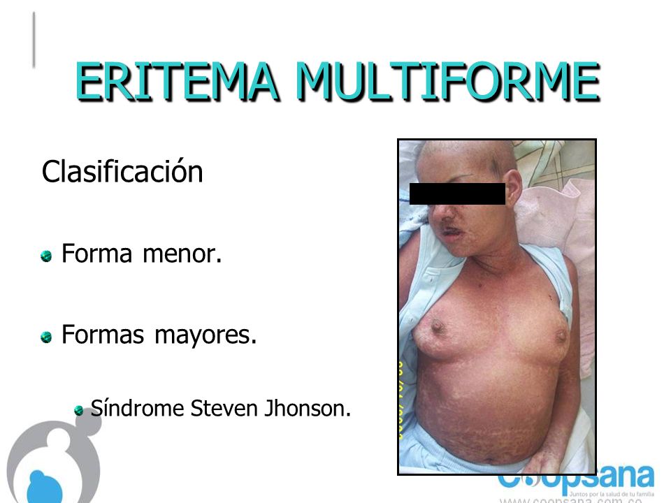 ERITEMA MULTIFORME Clasificación Forma menor. Formas mayores.