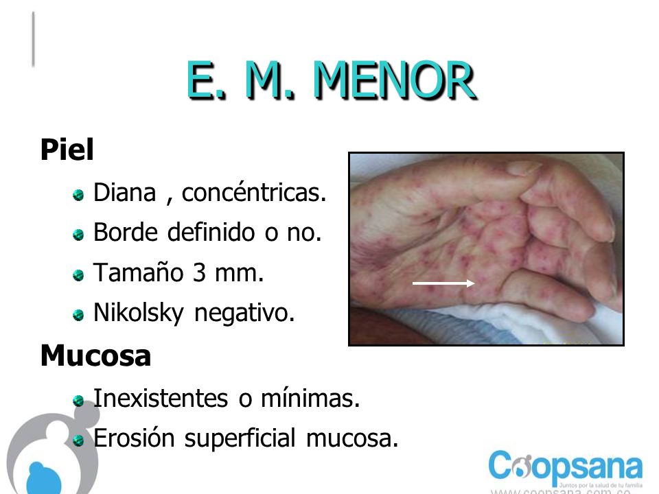 E. M. MENOR Piel Mucosa Diana , concéntricas. Borde definido o no.