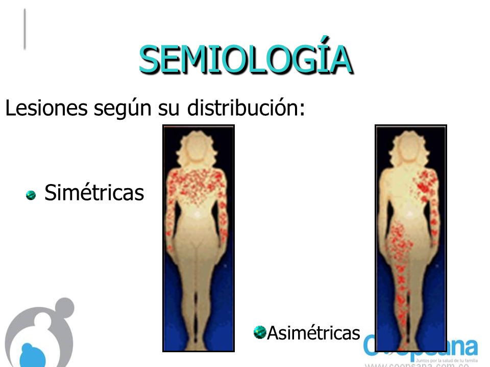 SEMIOLOGÍA Lesiones según su distribución: Simétricas Asimétricas