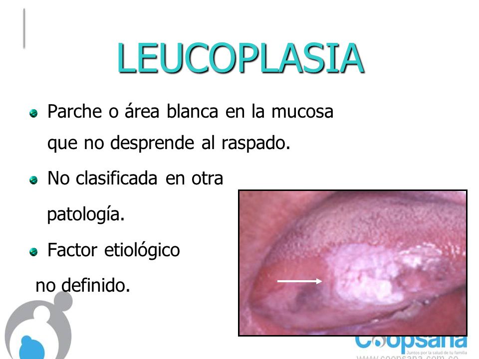 LEUCOPLASIA Parche o área blanca en la mucosa que no desprende al raspado. No clasificada en otra.
