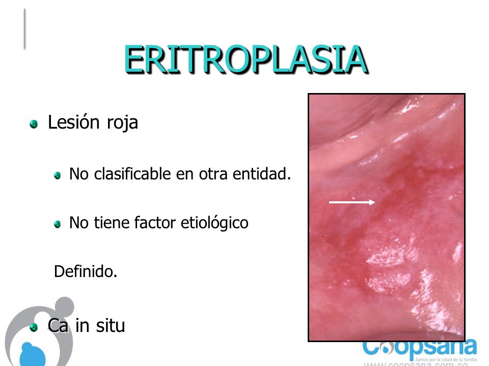 ERITROPLASIA Lesión roja Ca in situ No clasificable en otra entidad.