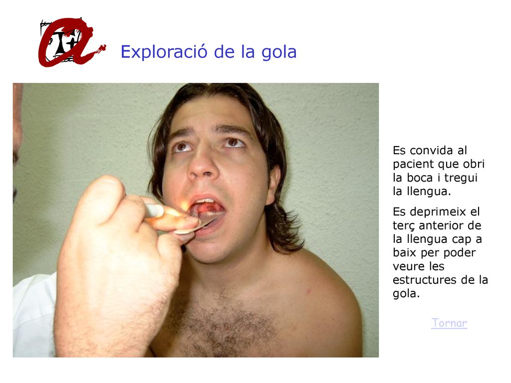 Exploració de la gola Es convida al pacient que obri la boca i tregui la llengua.