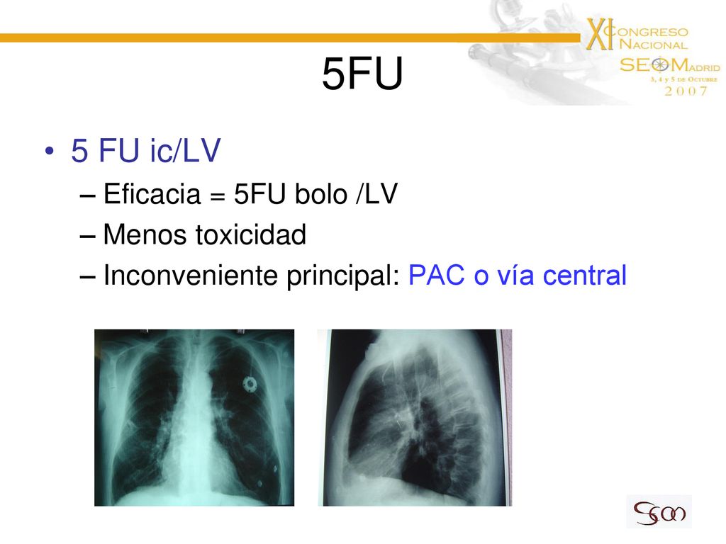 5FU 5 FU ic/LV Eficacia = 5FU bolo /LV Menos toxicidad