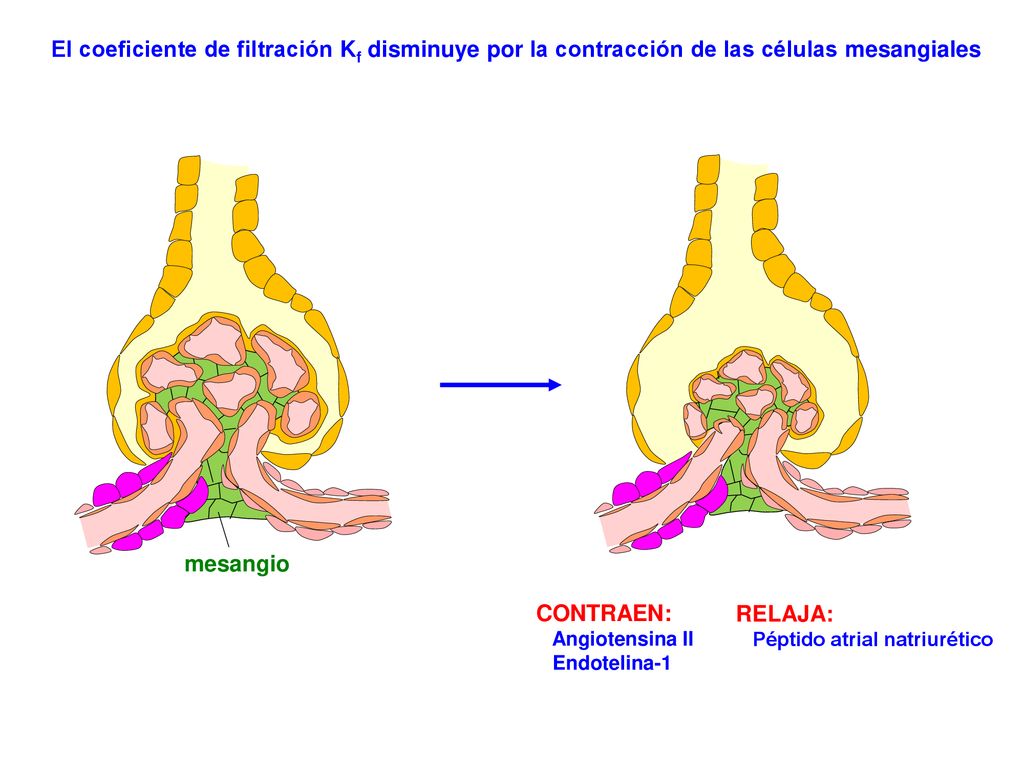 El coeficiente de filtración Kf disminuye por la contracción de las células mesangiales
