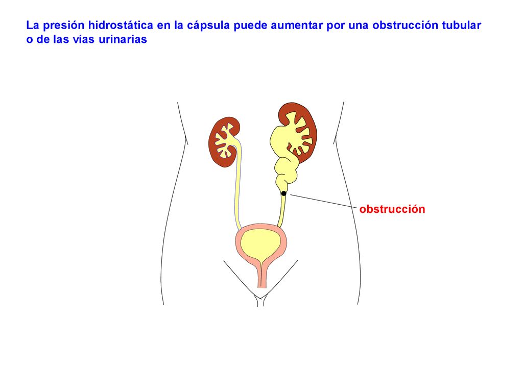 La presión hidrostática en la cápsula puede aumentar por una obstrucción tubular o de las vías urinarias