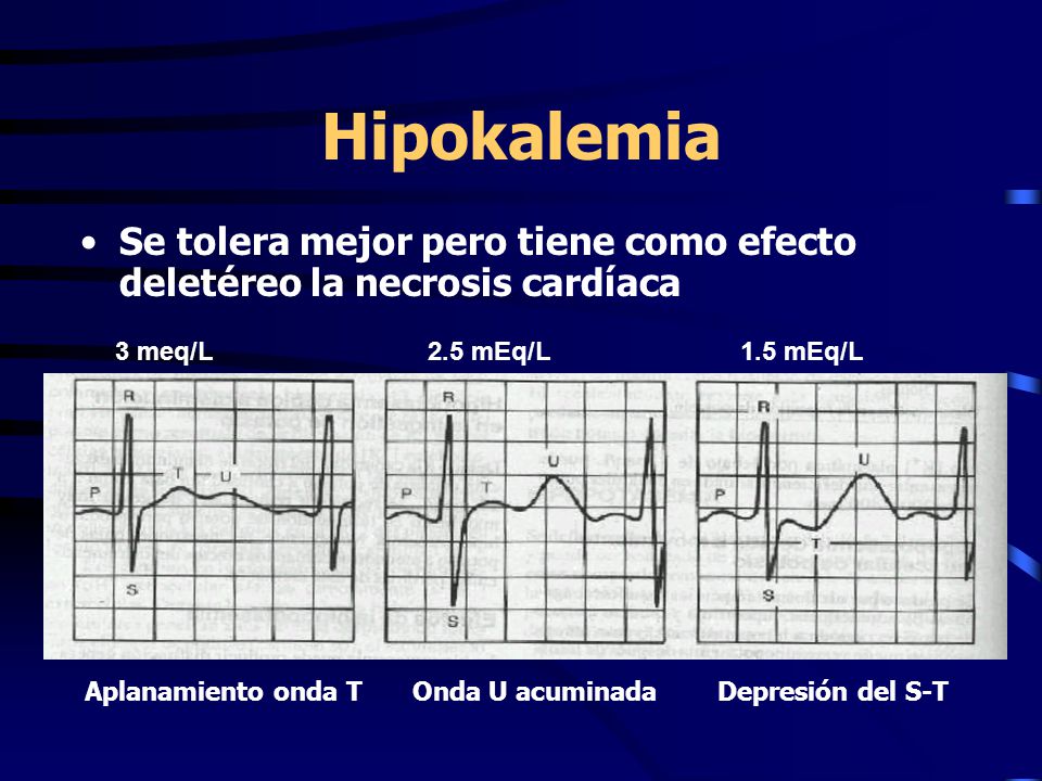Hipokalemia Se tolera mejor pero tiene como efecto deletéreo la necrosis cardíaca. 3 meq/L 2.5 mEq/L 1.5 mEq/L.