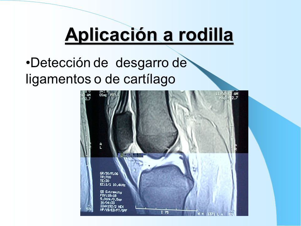Aplicación a rodilla Detección de desgarro de ligamentos o de cartílago