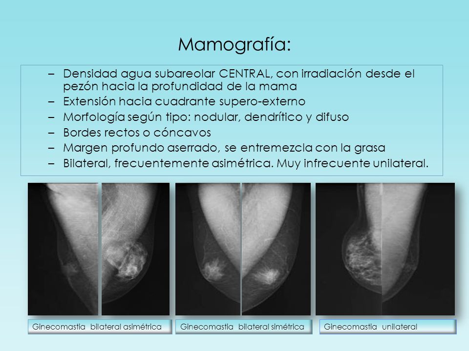 Mamografía: Densidad agua subareolar CENTRAL, con irradiación desde el pezón hacia la profundidad de la mama.