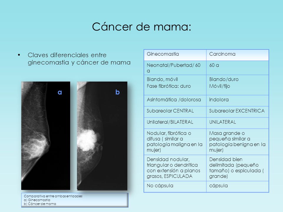 Cáncer de mama: Claves diferenciales entre ginecomastia y cáncer de mama. Ginecomastia. Carcinoma.