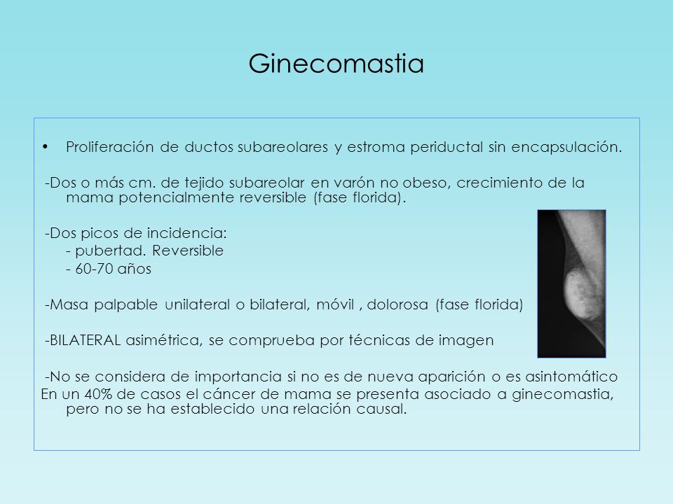 Ginecomastia Proliferación de ductos subareolares y estroma periductal sin encapsulación.