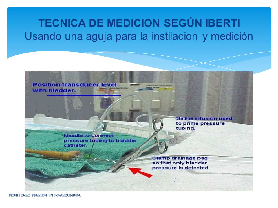 TECNICA DE MEDICION SEGÚN IBERTI Usando una aguja para la instilacion y medición