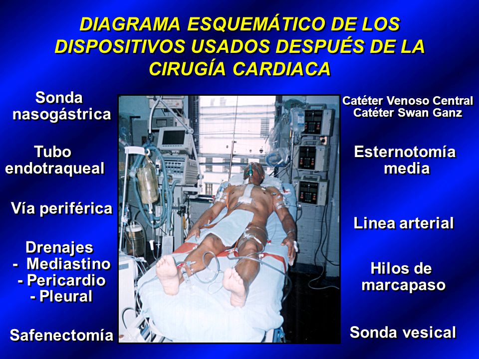 DIAGRAMA ESQUEMÁTICO DE LOS DISPOSITIVOS USADOS DESPUÉS DE LA CIRUGÍA CARDIACA