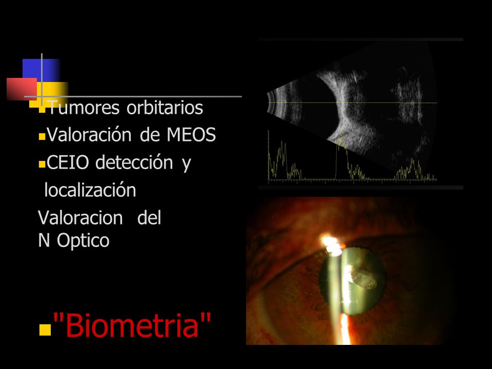 Otras Indicaciones Biometria Tumores orbitarios Valoración de MEOS