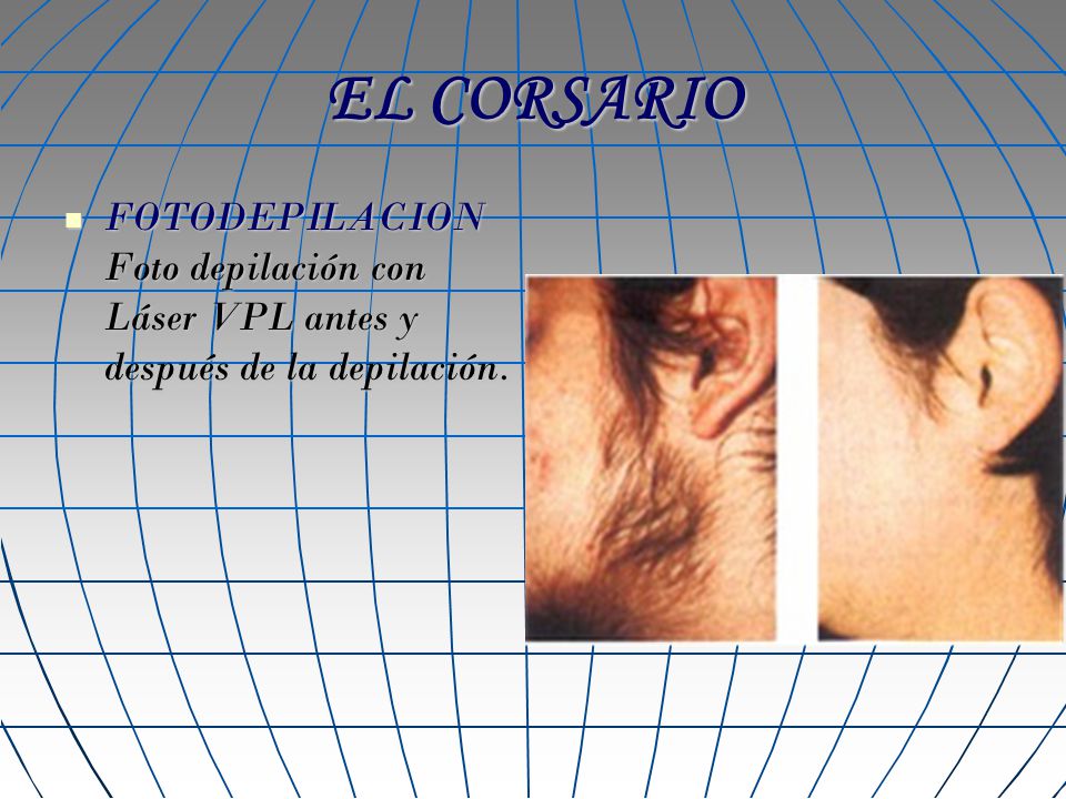 EL CORSARIO FOTODEPILACION Foto depilación con Láser VPL antes y después de la depilación.