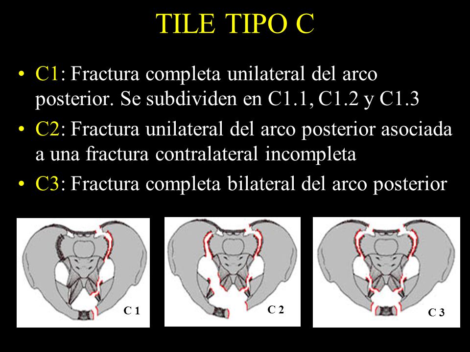 TILE TIPO C C1: Fractura completa unilateral del arco posterior. Se subdividen en C1.1, C1.2 y C1.3.