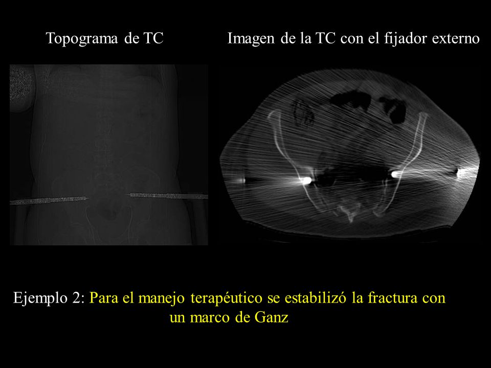 Topograma de TC Imagen de la TC con el fijador externo.