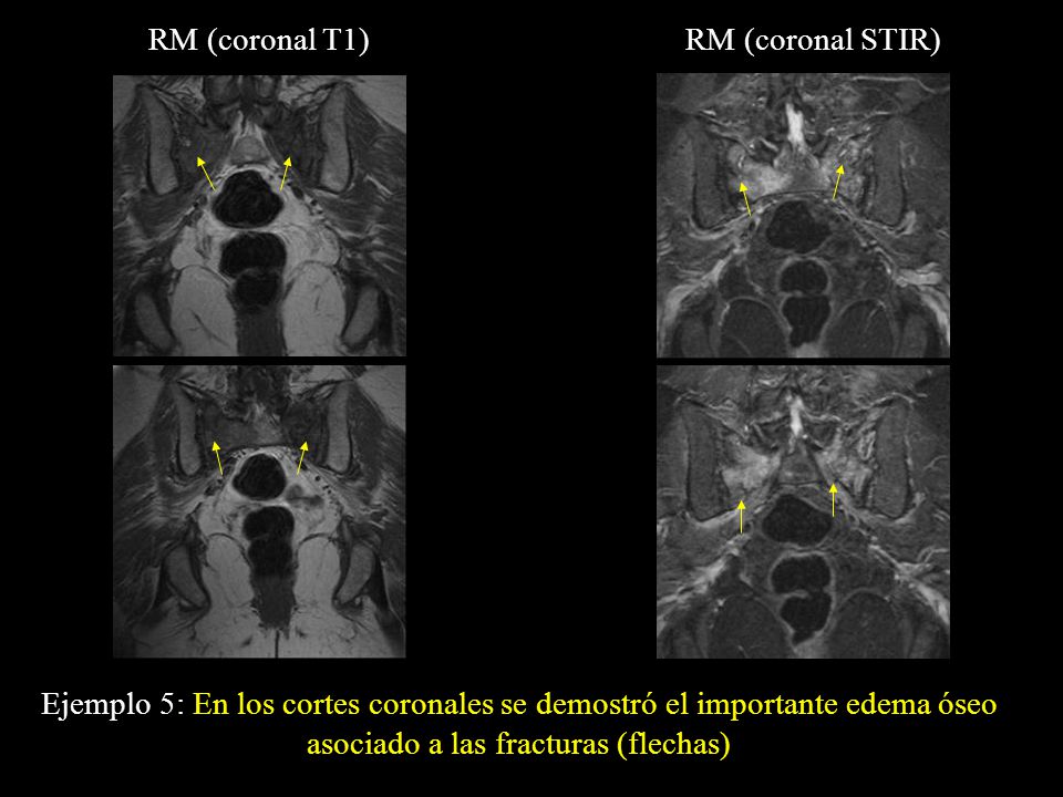 RM (coronal T1) RM (coronal STIR) Ejemplo 5: En los cortes coronales se demostró el importante edema óseo asociado a las fracturas (flechas)