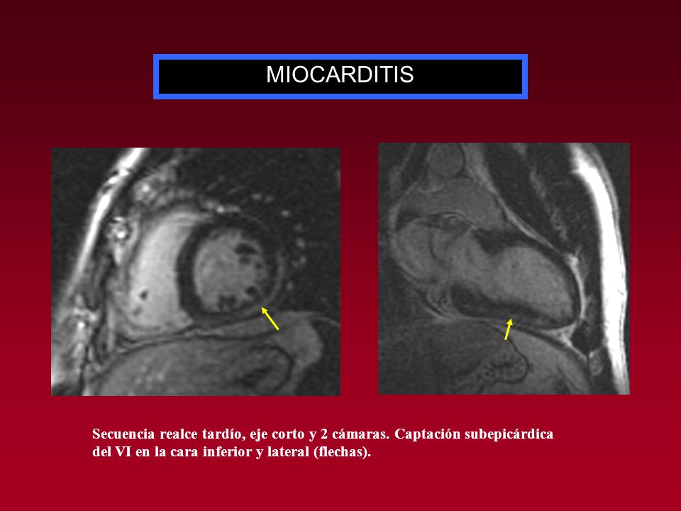 MIOCARDITIS Secuencia realce tardío, eje corto y 2 cámaras.
