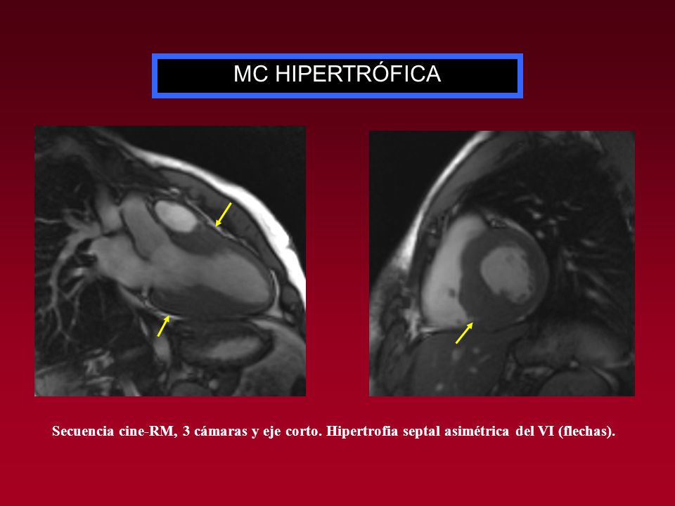 MC HIPERTRÓFICA Secuencia cine-RM, 3 cámaras y eje corto.