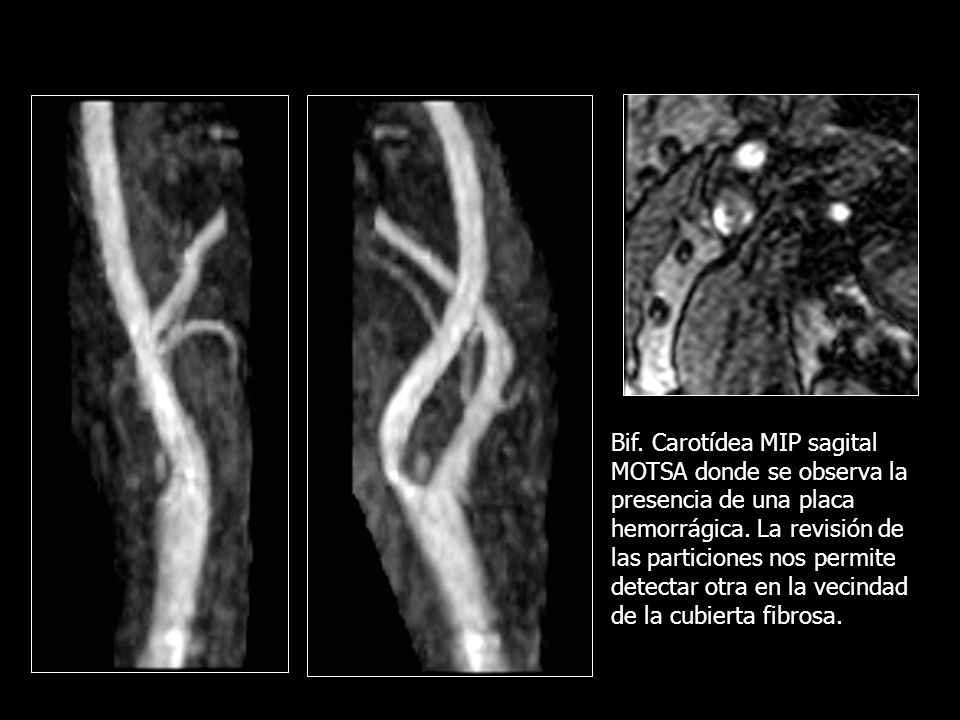 Bif. Carotídea MIP sagital MOTSA donde se observa la presencia de una placa hemorrágica.