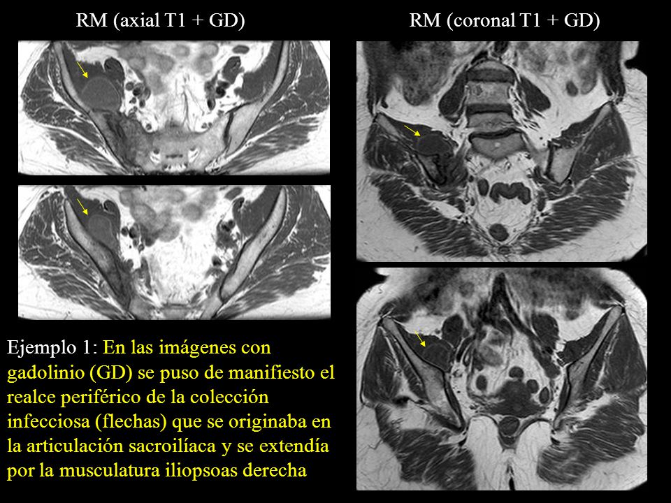 RM (axial T1 + GD) RM (coronal T1 + GD)