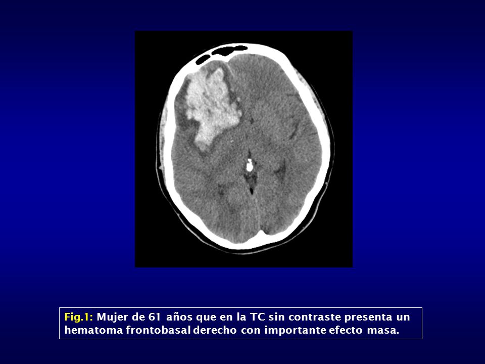 Fig.1: Mujer de 61 años que en la TC sin contraste presenta un hematoma frontobasal derecho con importante efecto masa.