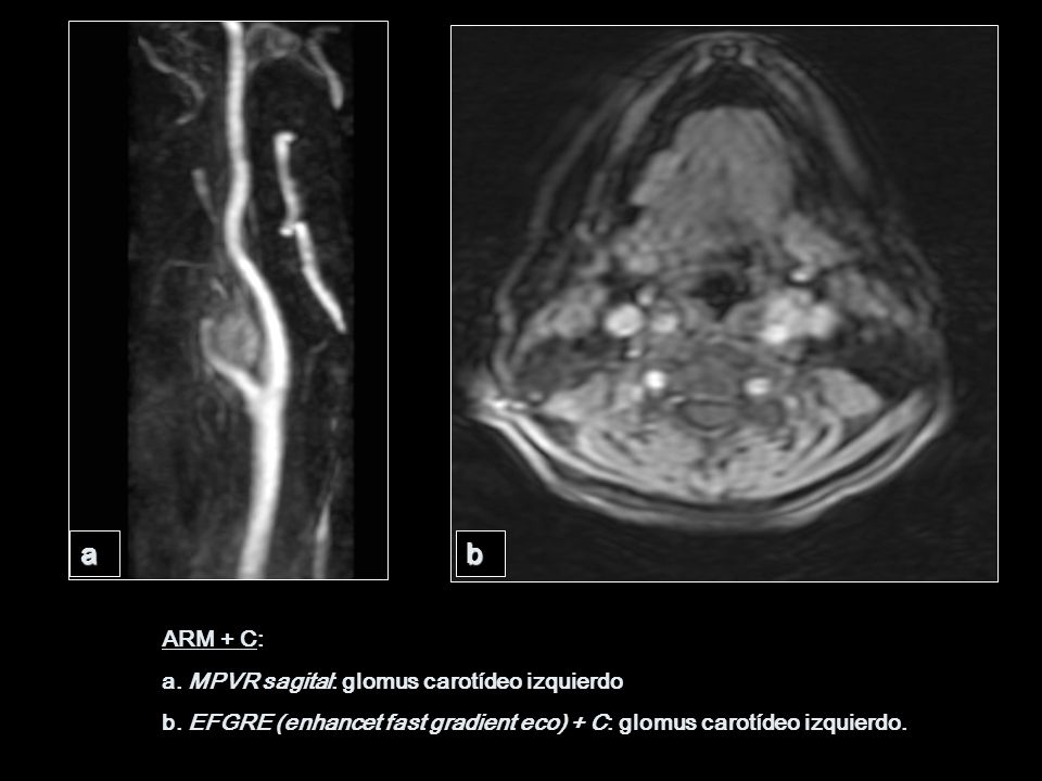 a b ARM + C: a. MPVR sagital: glomus carotídeo izquierdo