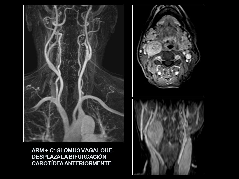 ARM + C: GLOMUS VAGAL QUE DESPLAZA LA BIFURCACIÓN CAROTÍDEA ANTERIORMENTE