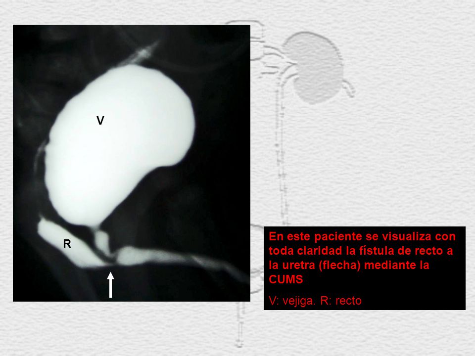 V En este paciente se visualiza con toda claridad la fístula de recto a la uretra (flecha) mediante la CUMS.