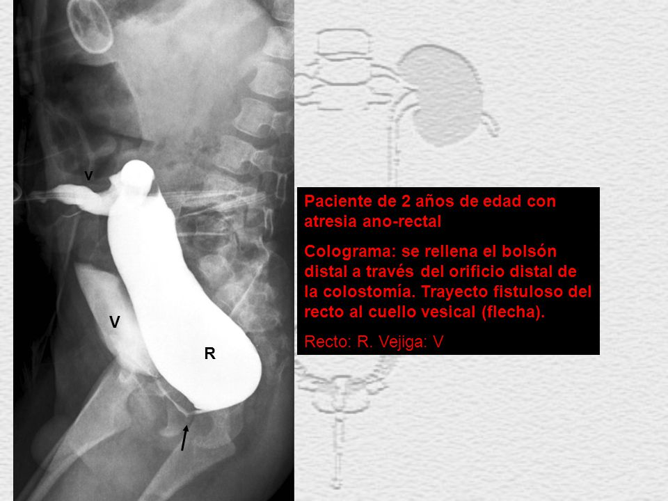 v Paciente de 2 años de edad con atresia ano-rectal.
