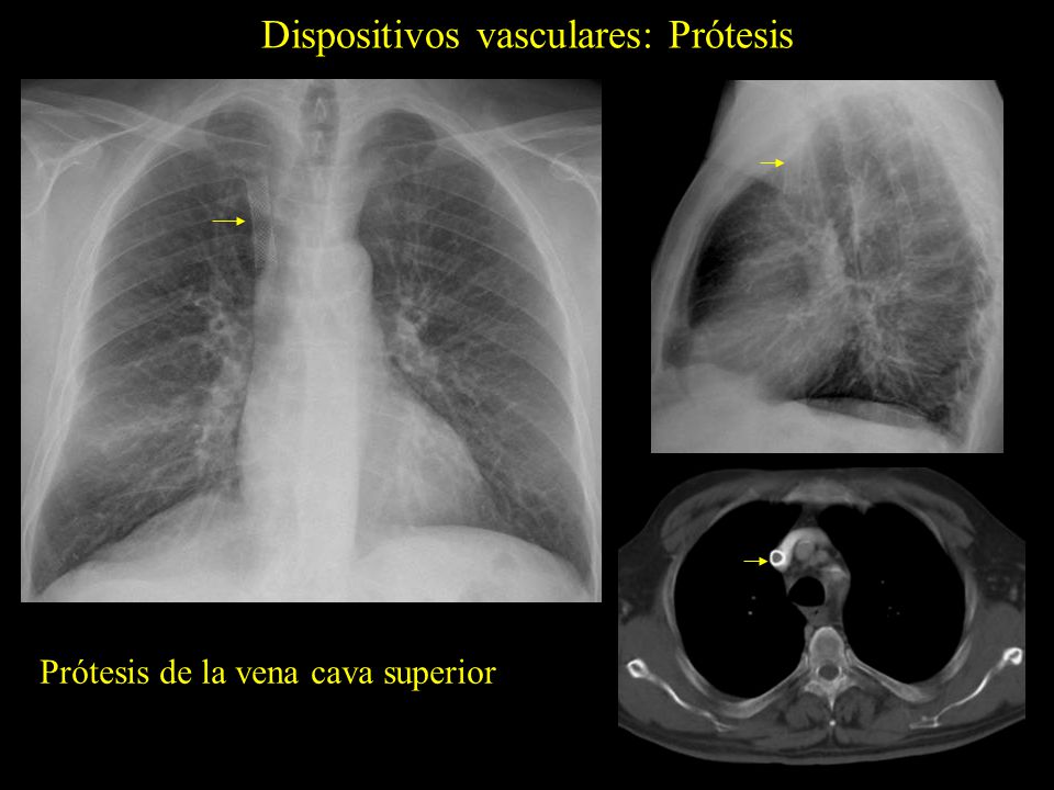 Dispositivos vasculares: Prótesis