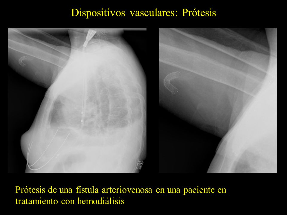 Dispositivos vasculares: Prótesis