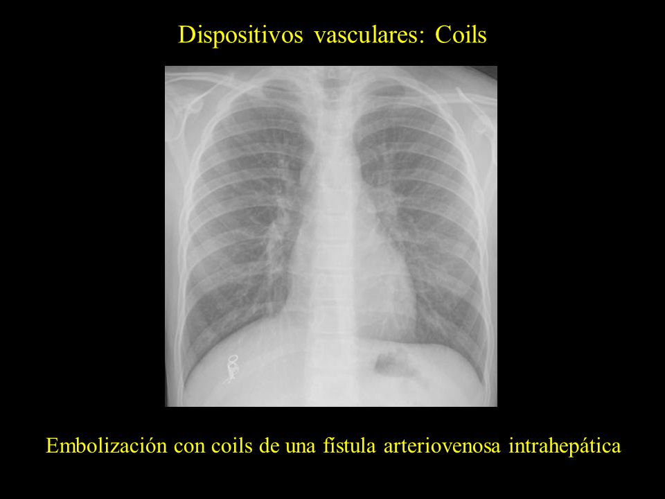 Dispositivos vasculares: Coils